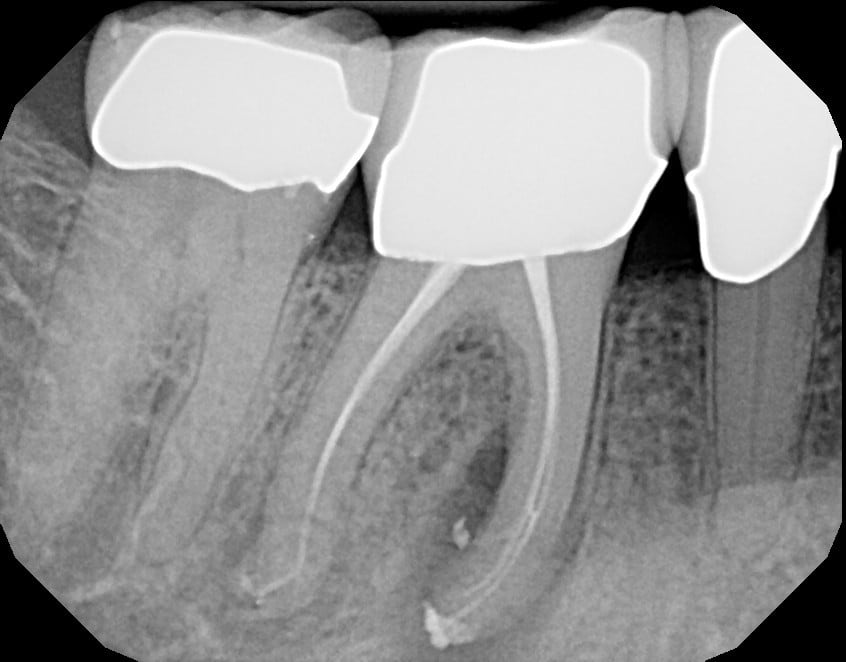 Root Canal Therapy