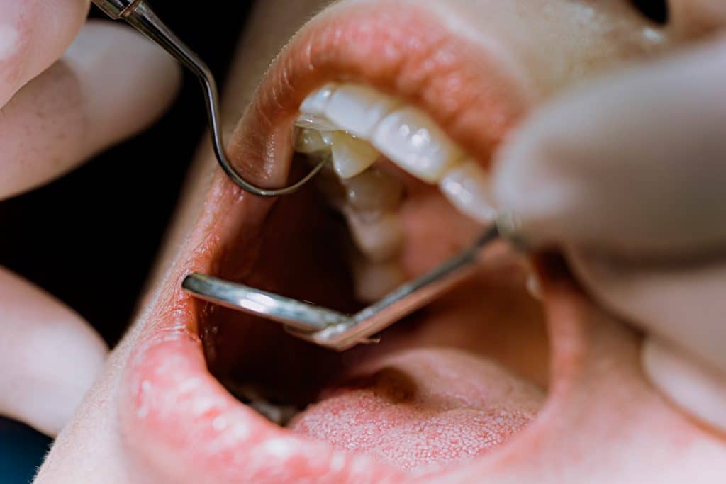 Choose Endodontic Care In A Dental Emergency