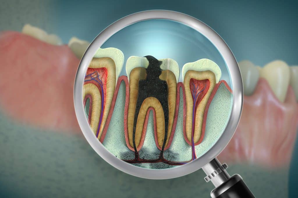 Recovery Timeline After Root Canal Therapy: What Hudson Patients Should Expect