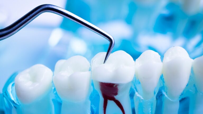 Root Canal Treatment