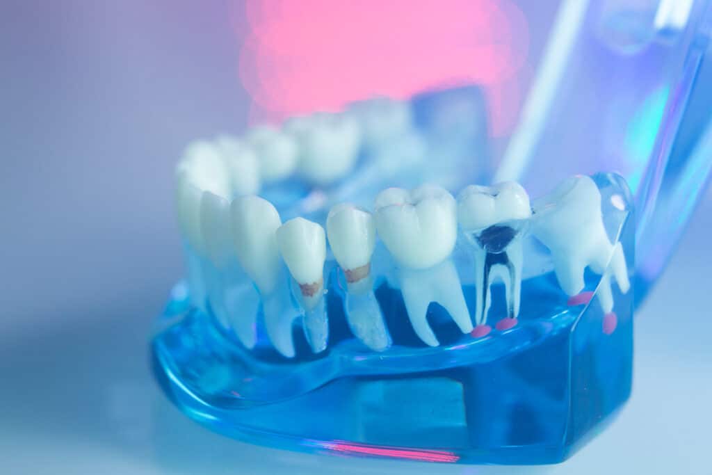 Root Canal vs. Extraction: Making the Right Choice for Your Long-Term Oral Health