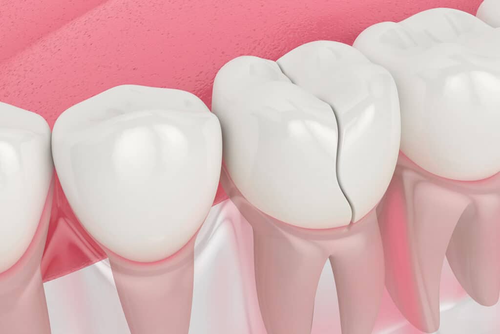 The Hidden Dangers of Untreated Cracked Teeth for Moultonborough Residents