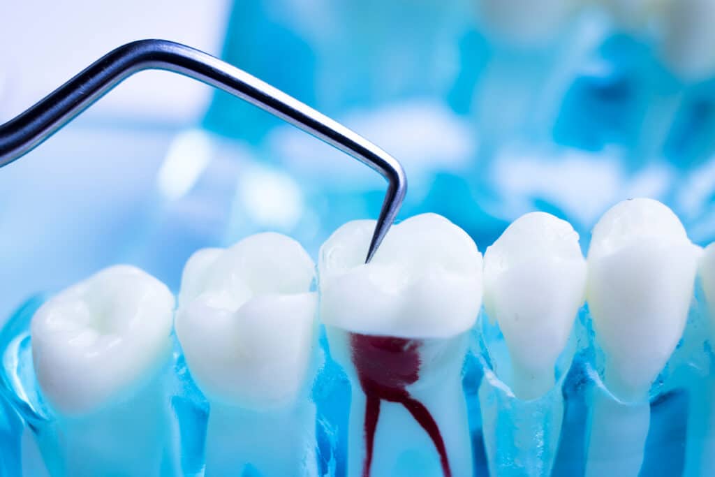 What To Eat After Root Canal Treatment