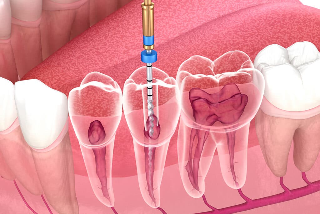 When to See an Endodontist vs. a General Dentist: A Guide for NH Residents
